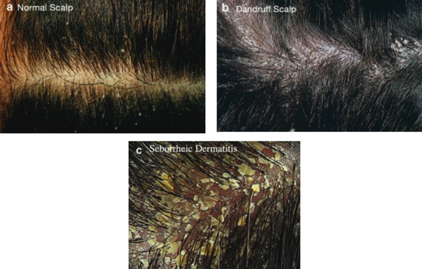 Как отличить перхоть от. Себорейный дерматит трихология. Себорея волосистой части кожи головы препараты. Асбестовидный себорейный дерматит.