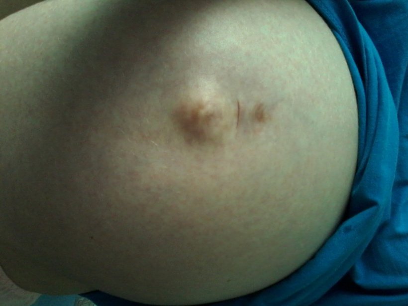 Сыпь на животе при беременности фото